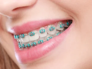 average price of braces in canada 2026